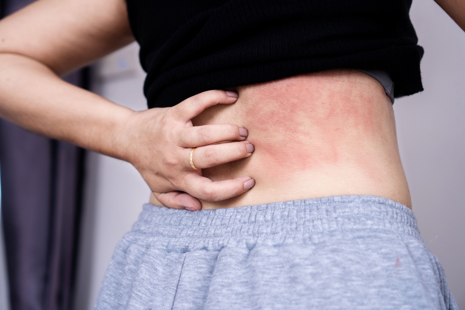 woman suffering from skin disease hand scratching on her  itchy back due to allergy to sweat