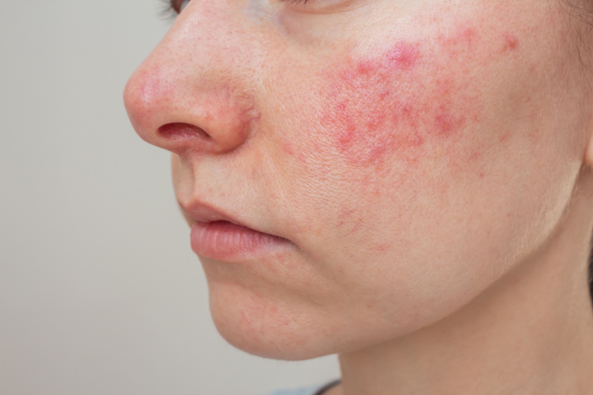 woman suffering from the skin chronic disease rosacea on her face in the acute stage.