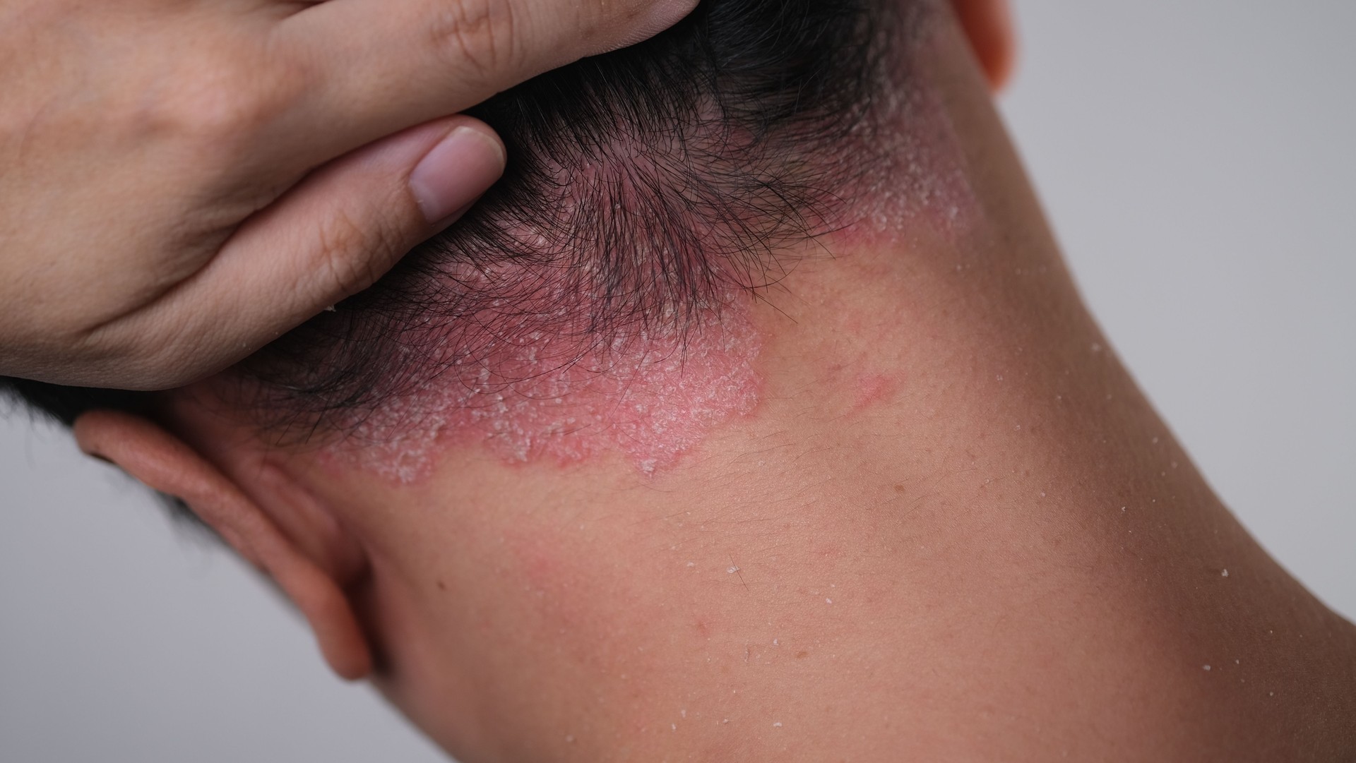 Psoriasis on the nape of a man. skin with psoriasis.